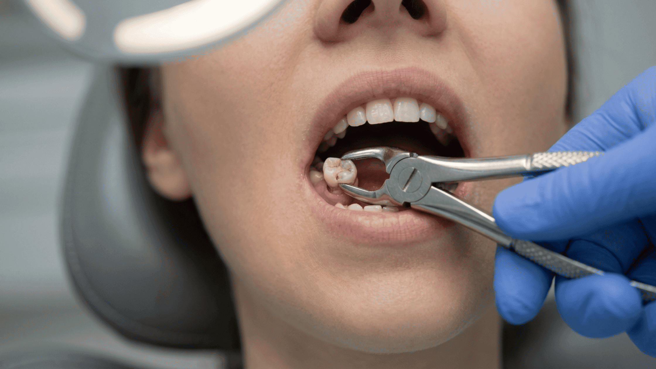 moss dental tooth extraction