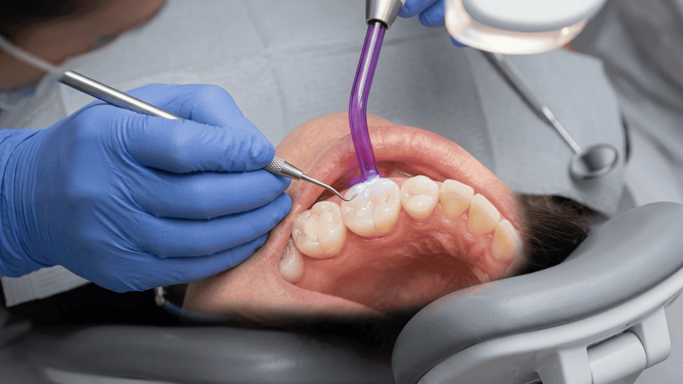 moss dental fillings