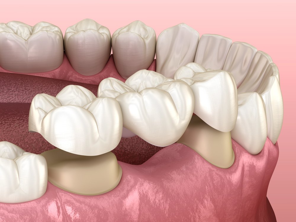 Dental bridge restoration illustration