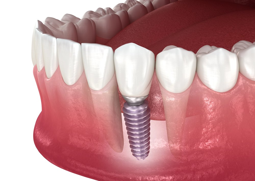 Dental implant and ceramic crown illustration