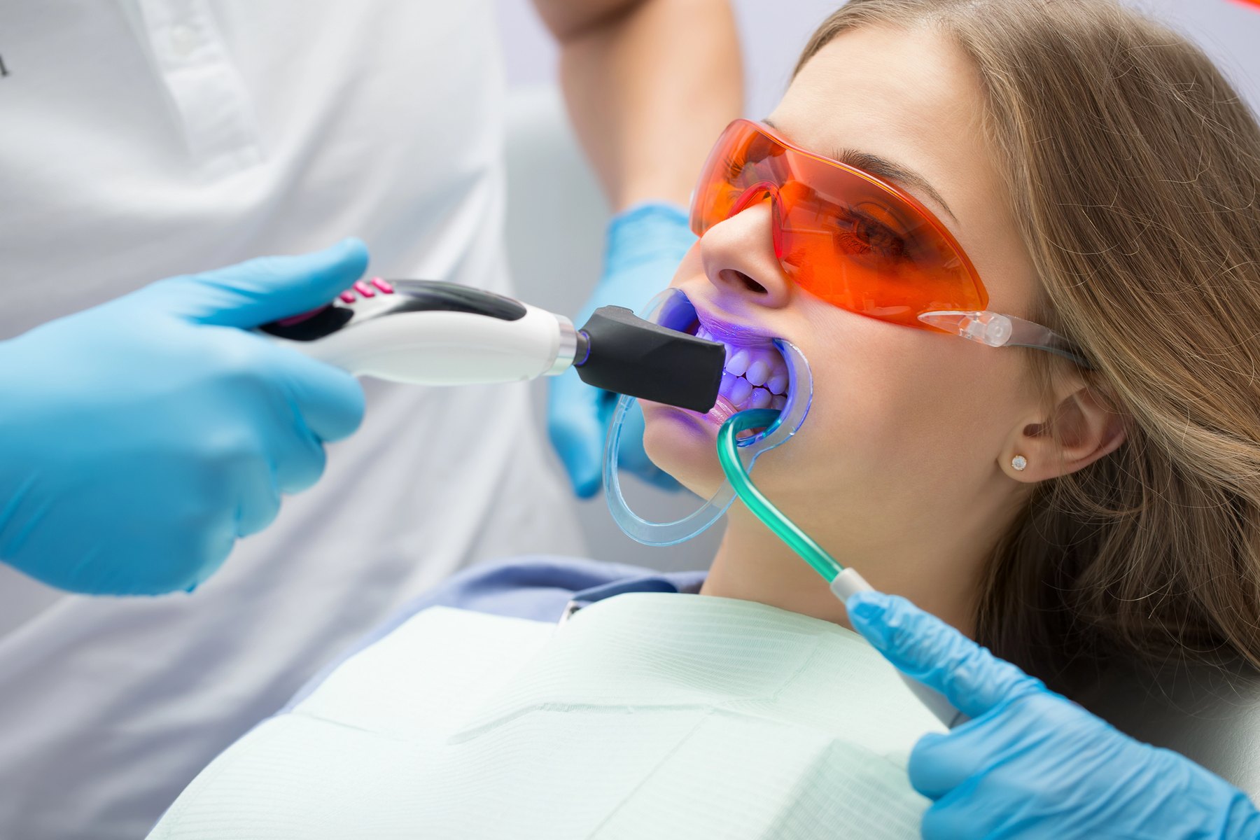 Dental sealant cured with a polymerization light