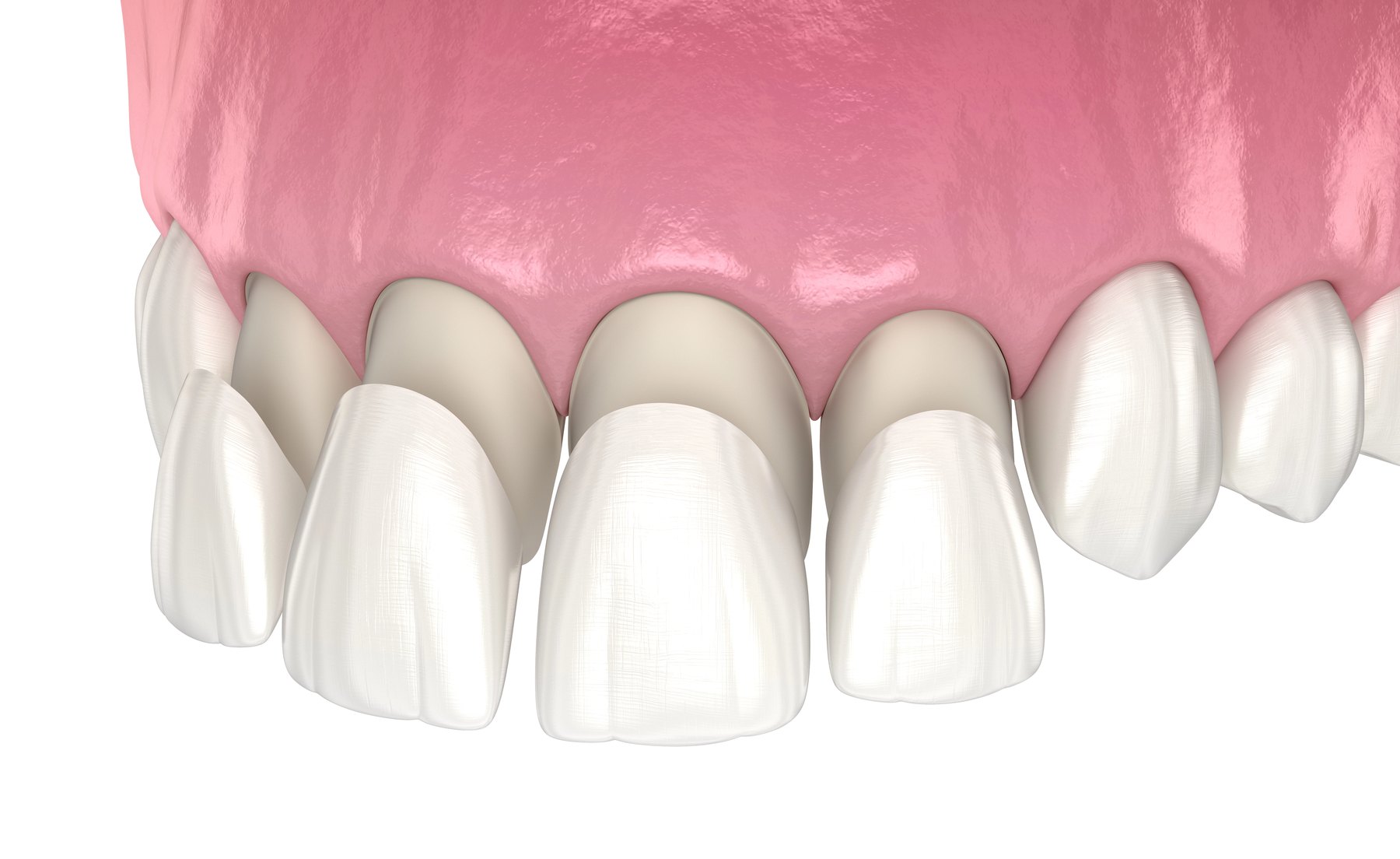 Dental veneer placement illustration