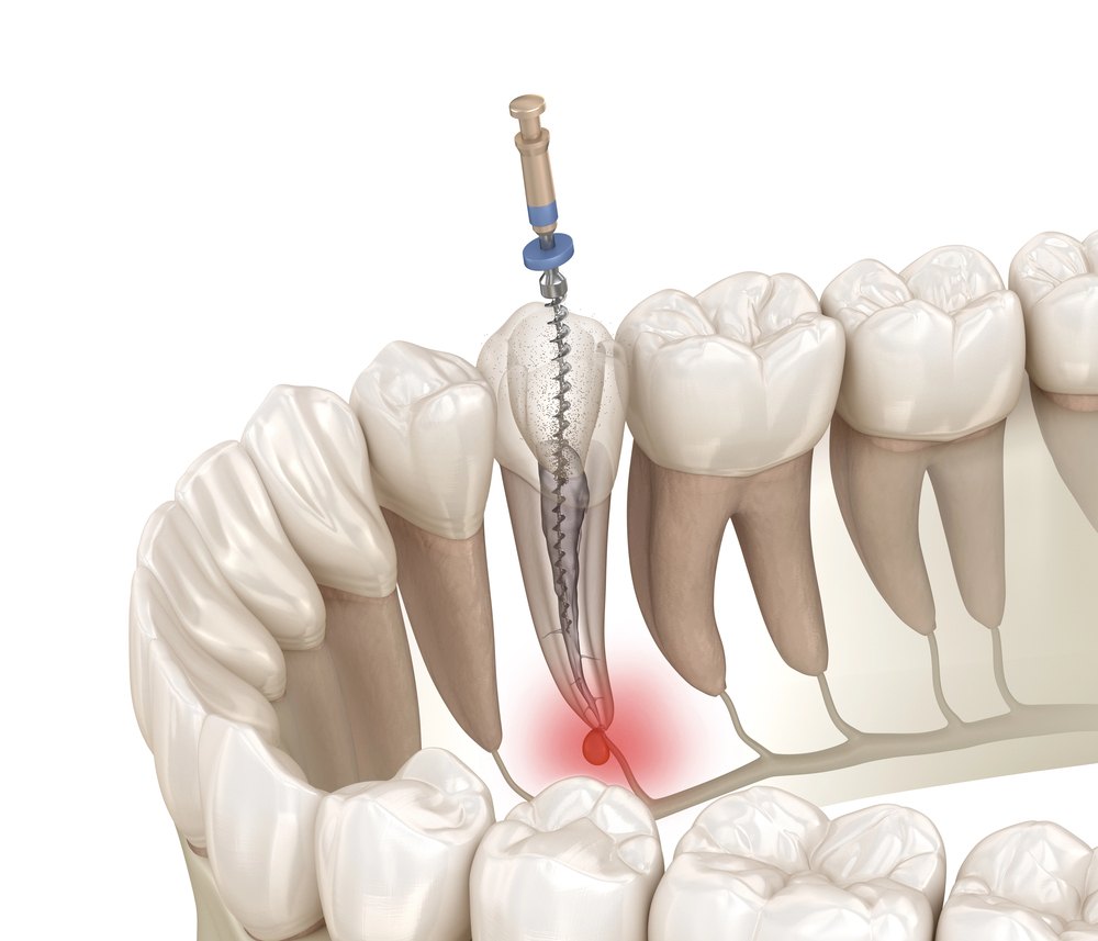 Root canal treatment illustration