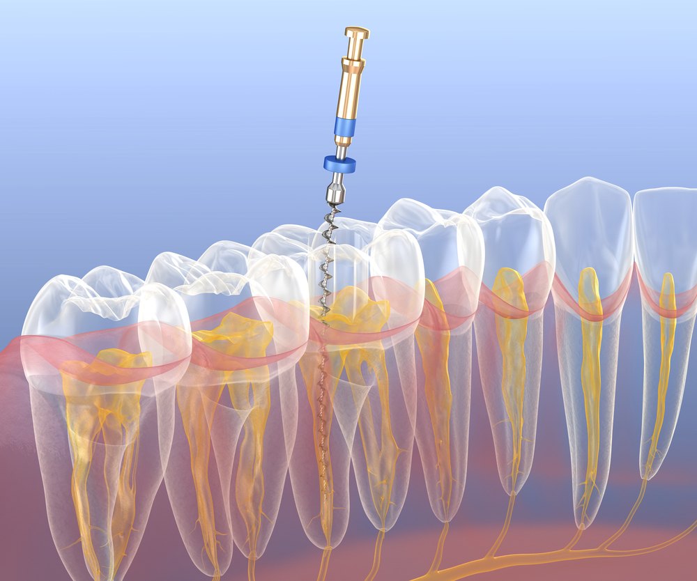 Root canal treatment process illustration