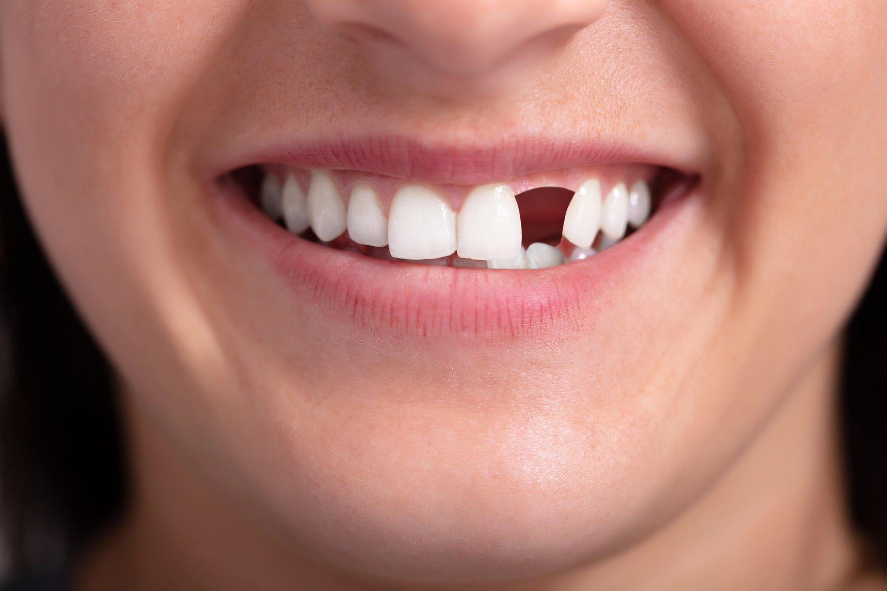 Young woman with a missing tooth