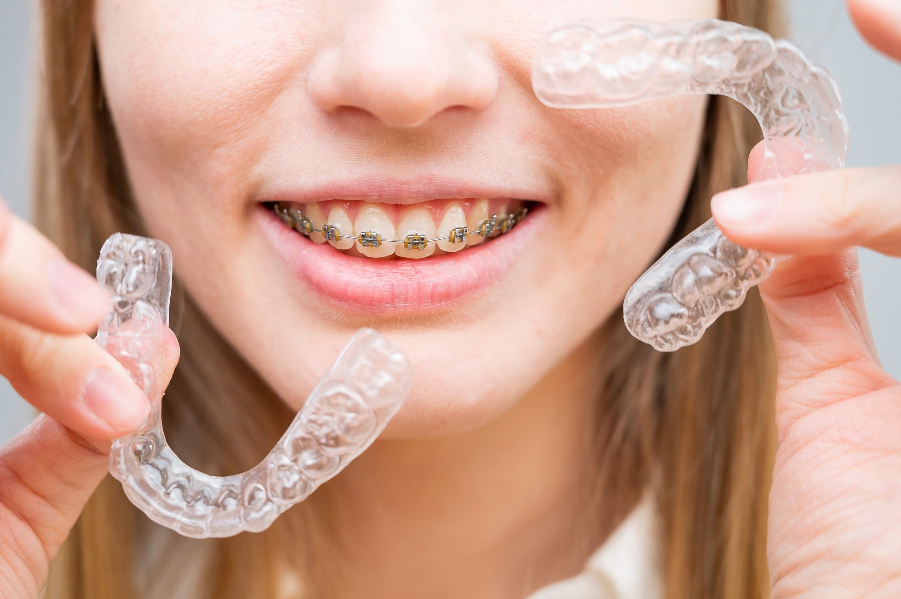Person holding clear aligners near a smile with braces