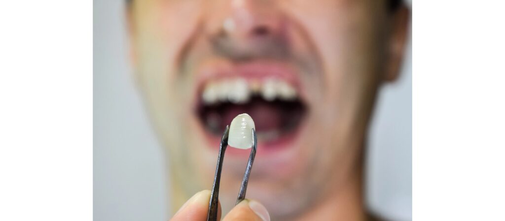 Dental crown held with tweezers in front of an open mouth.