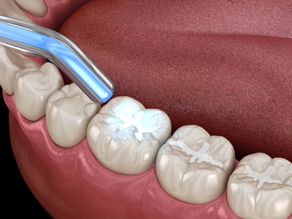 Dental filling cured with a polymerization light