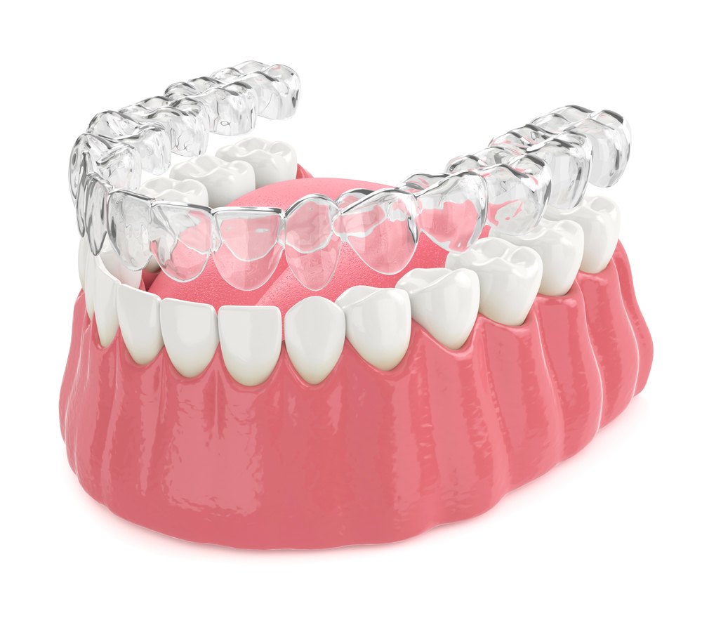 Clear aligner illustration