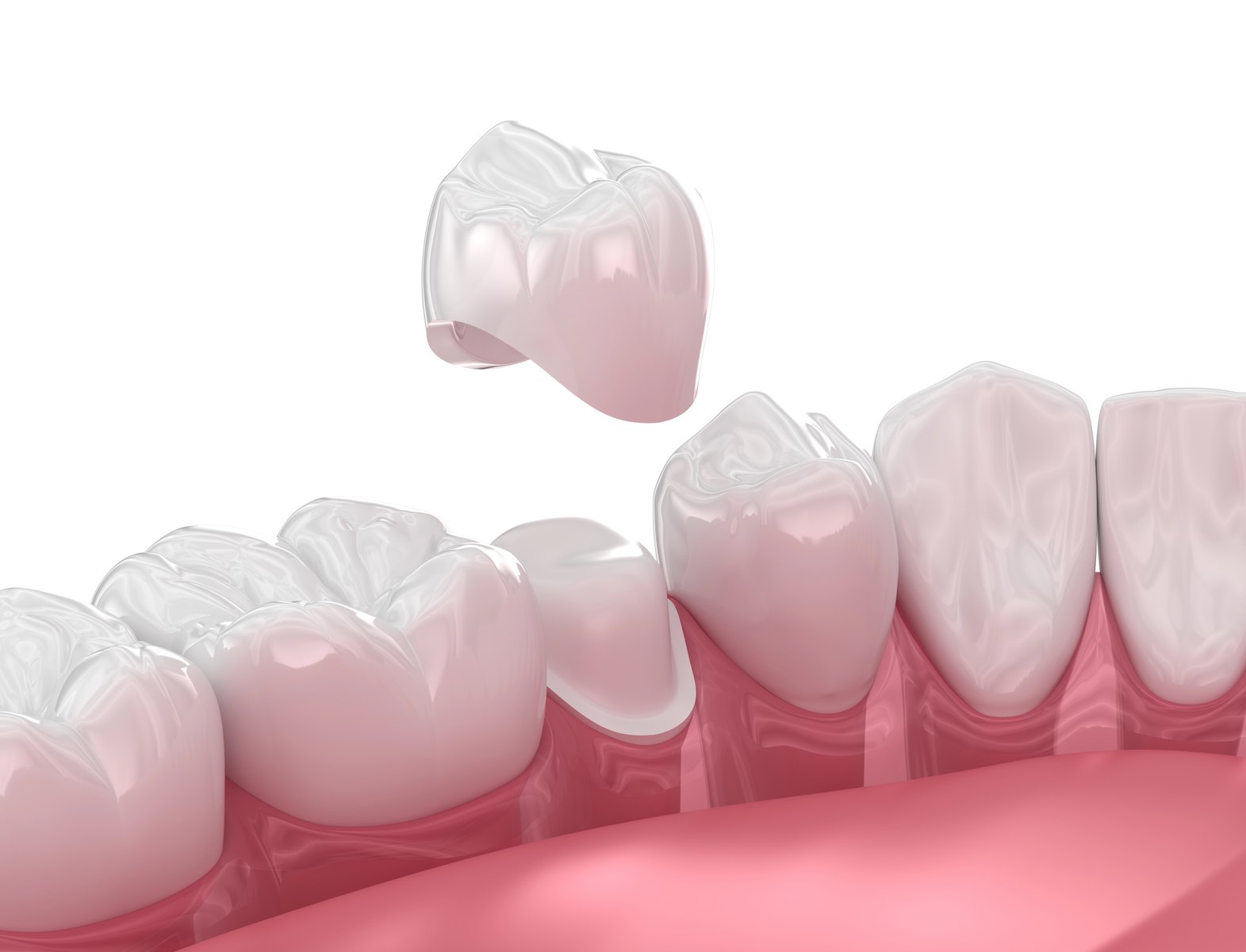 Dental crown placement illustration